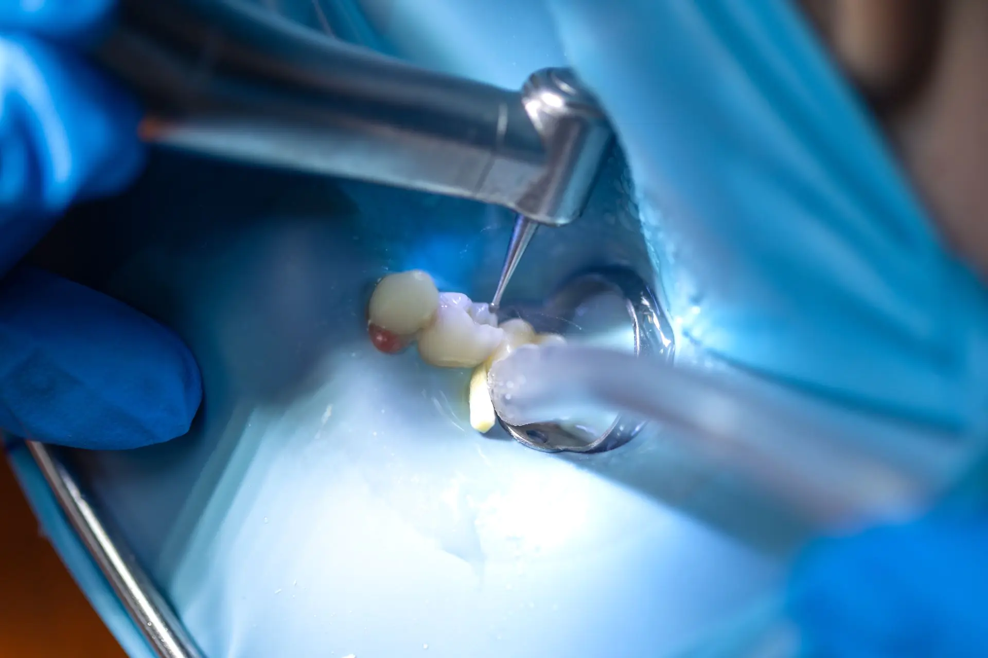 Wortelkanaalbehandeling